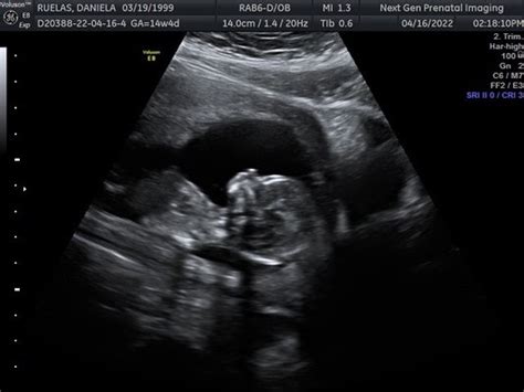 Ultrasound Sacramento CA: Your Comprehensive Guide to Prenatal Imaging