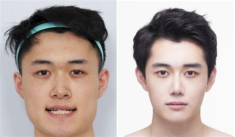 Can Asian Men Look White Through Surgery?