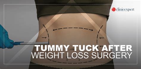 Allen by ABS: Empowering the Future of Abdominoplasty