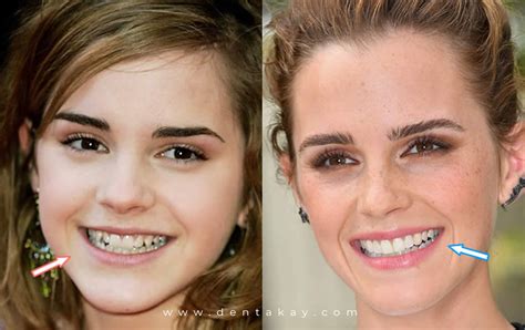 Emma Stone Veneers: A Smile to Rival Hollywood’s A-Listers