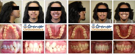 Granger Orthodontics: Revolutionizing Smiles in West Valley