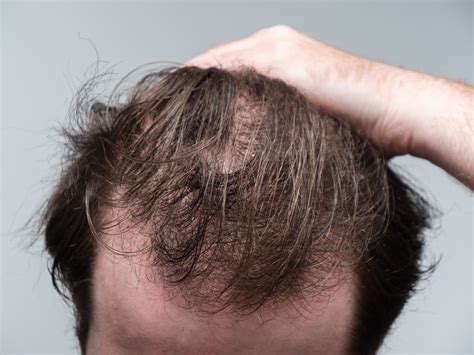 Hair Loss Zepbound: An In-Depth Exploration