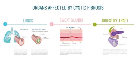 Cystic Fibrosis-Affected Organelles: A Comprehensive Guide